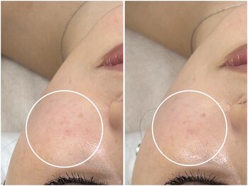 アンリミット 原宿竹下通り店(Une limit)/【理想のお肌に向けて】