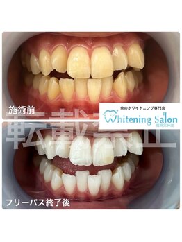 ホワイトニングサロン 福岡天神店/ホワイトニング