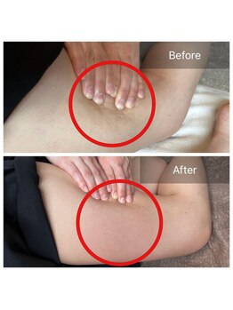 アピアランスビューティー 表参道店/セルライトのビフォー/アフター