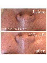 ステライチマルサン(stella.103)/ハイドロ毛穴洗浄