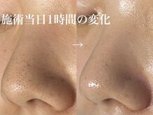 レイ(Rey)/毛穴の黒ずみ改善