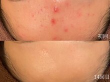 ウォーム(warm)/【肌質改善専門店warm】肌質改善