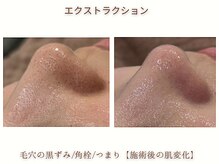 ミリ(MiLi)/つまり毛穴・黒ずみ毛穴・角栓