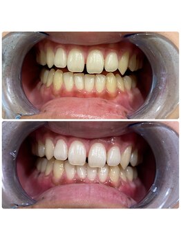 コナホワイトニング 神保町/セルフホワイトニング神保町