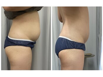 FJ/脂肪撃退コース◇今年こそ美BODY