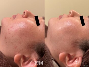 ウォーム(warm)/ニキビケア/肌荒れ/ニキビ肌