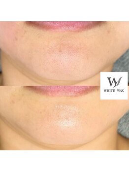 ホワイトワックス 新潟万代店(WHITE WAX)/ビフォーアフター(口周り)