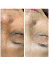 シーカラー 中野栄店(C.color)/シミケア結果◎60代女性