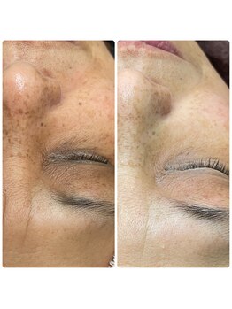 シーカラー 中野栄店(C.color)/シミケア結果◎60代女性