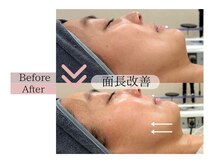 フロリール アザブジュウバン(FlorirAzabujuban)/小顔/リフト/たるみケア