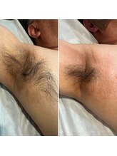 トリプルワン(111)/メンズボディWAX脱毛