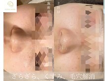 サロンドレナ 名駅店/ハーブピーリング サロンドレナ