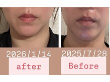 リ シェリール(Re cherir)/エラスチンサプリ