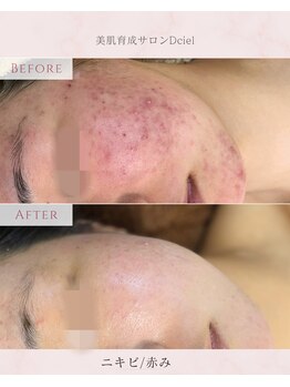 ディシエル(D'ciel)/ニキビ/跡/赤み/敏感肌