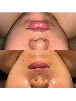 ヴィーナス(Venus)/ほうれい線改善