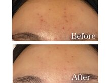 MMK/おでこの凹凸もさようなら♪