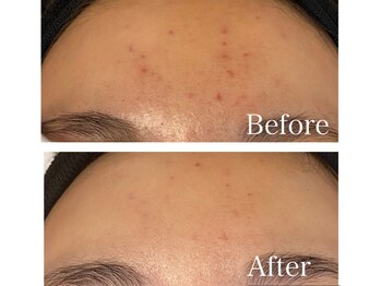 MMK/おでこの凹凸もさようなら♪