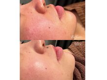 フジグラン安芸ベルミーランドの雰囲気（顔脱毛+パック施術1回☆パックの鎮静効果で赤みも引いてます◎）