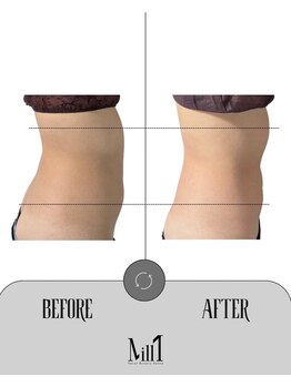 ミル 恵比寿店(Mill)/《痩身》