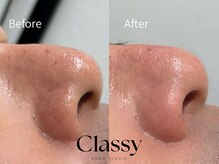 鼻の黒ずみ/角栓/毛穴汚れOFF!清潔感UP!!