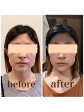 クリーム 京都店(Cream)/エラ、あご、ほっぺ。