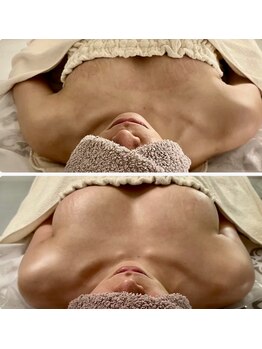 サロン アイミー(salon i me)/【バストアップ】症例