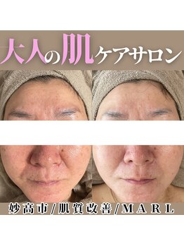 マール(MARL.)/50代お客様の症例♪~毛穴~