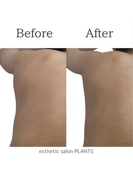 プランツ(PLANTS)/20代／１回／肩凝り腰痛