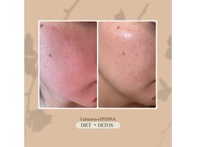 ヨサパーク モク 茶 武蔵新田店(YOSA PARK MOKU)の雰囲気(美肌◎むくみもスッキリ!内側から潤すハーバルエステ)