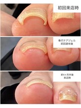 ケアプラス(care plus)/巻爪ケアジェル