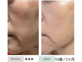 ハイケア グラン ギンザ(HYCARE GRAND GINZA)/日本ーの肌改善サロン実力/銀座