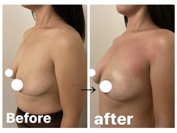 プレフィール(PLEAFEEL)/バストケア◇症例◇たまプラーザ