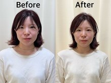 まごころ整骨院/百美鍼Before＆After（1回施術）