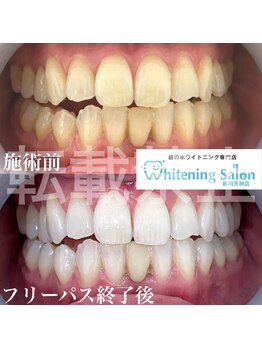 ホワイトニングサロン 福岡天神店/ホワイトニング