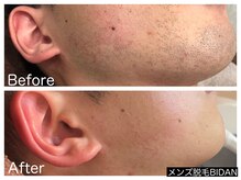 ビダン(BIDAN)/ヒゲ脱毛　BeforeAfter