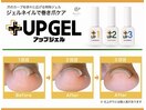 【巻き爪ケア】UP GEL