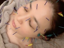 オン 蕨駅西口(ON)/美容鍼【小顔/フェイシャル】