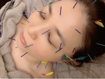 オン 蕨駅西口(ON)/美容鍼【小顔/フェイシャル】