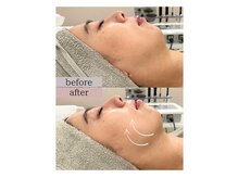 フロリール アザブジュウバン(FlorirAzabujuban)/3D小顔/造顔フェイシャル