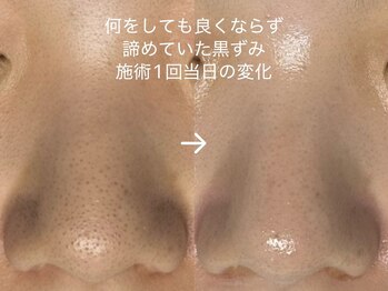 レイ(Rey)/何してもダメだった毛穴黒ずみ