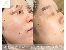 サロンドレナ 名駅店/ハーブピーリング サロンドレナ