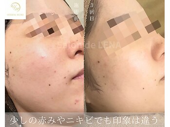 サロンドレナ 名駅店/ハーブピーリング サロンドレナ