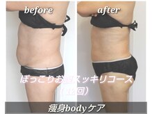 フェリーチェ(felice)/施術例／ウエスト引き締め
