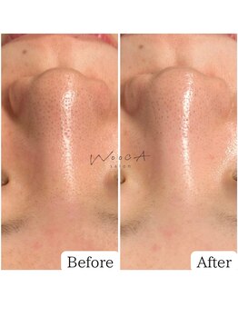 サロン ウーカ(salon WOOCA)/ハイドラ×REVI【毛穴】