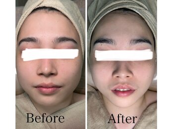 ルミネル 名古屋新栄(Luminelle)/毛穴×美白