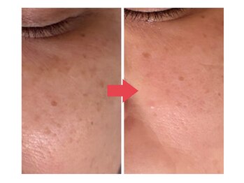 リノエデボーテ(Rinoe’ de beaute)の写真/【シミにお悩みの人へ】透明感を改善する大人の本格ケア！一人ひとりに合わせたカウンセリング◎