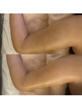 インディバサロン アンド(&.)/二の腕術後ケア