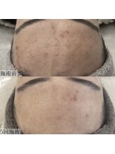 ヴェルシック(Belchic)/おでこも自信を持てるように