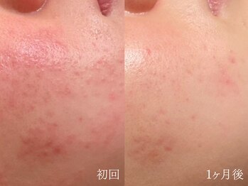 ウォーム(warm)/【肌質改善専門店warm】肌質改善