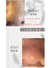 美箱 赤坂店/☆集中毛穴洗浄コース☆